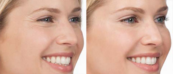 Real patient BOTOX before and after photo