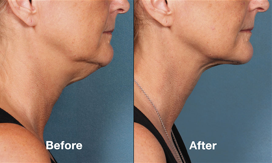 Kybella patient before and after photo