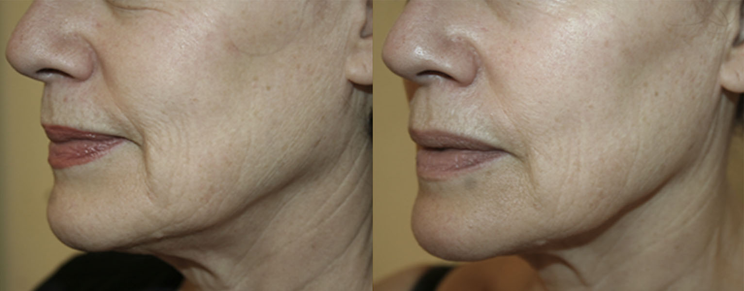 Real patient RF Microneedling before and after photo